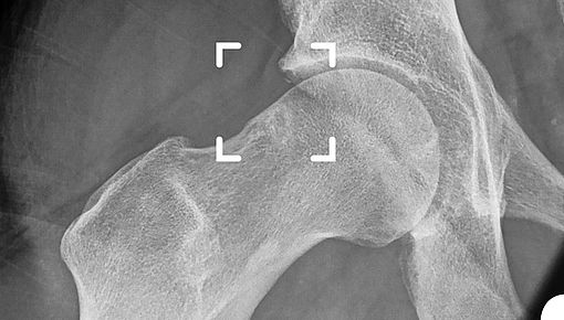 Arthroplastische Hüftumformung